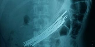 Cuộn dây thép trong ổ bụng nạn nhân.