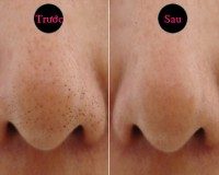 Sạch mụn đầu đen chỉ với bí quyết đơn giản