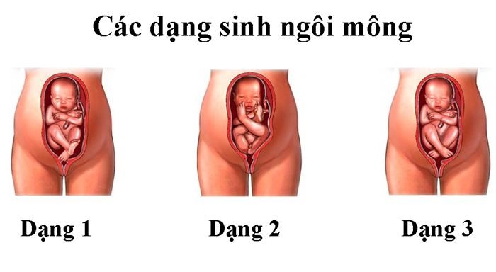 Kiến thức quan trọng về sinh ngôi mông mẹ cần biết