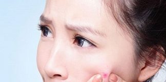 Trị mụn bọc cho da nhạy cảm với nước cốt chanh