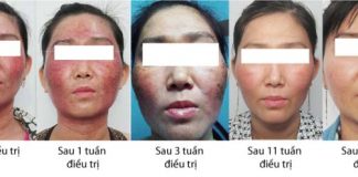 hậu quả trắng da cấp tốc 