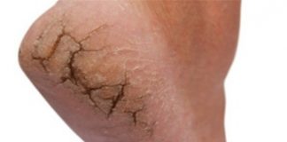 trị nứt gót chân 