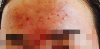 thuốc trị mụn gây vô sinh 