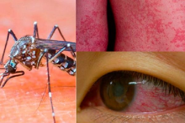 Dấu hiệu và cách phòng tránh nhiễm virus Zika