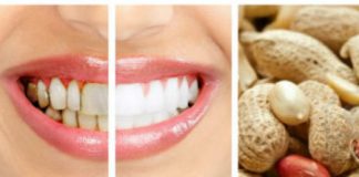 lấy cao răng tại nhà