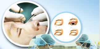 biến chứng do cắt mí