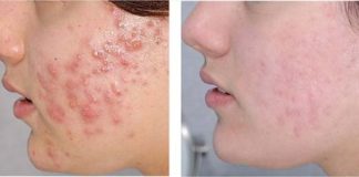 chữa dị ứng mỹ phẩm 