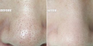 thu nhỏ lỗ chân lông ở mũi