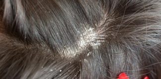 cách trị gàu hiệu quả