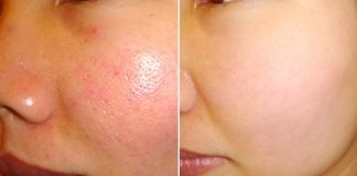 chữa viêm lỗ chân lông 