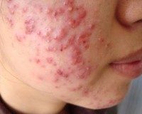 Thói quen khiến bạn bị mụn ngày càng nghiêm trọng