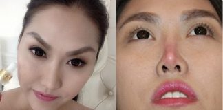 Biến chứng phẫu thuật thẩm mỹ khiến sao Việt lao đao