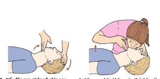 Sơ cứu trong những trường hợp khẩn cấp