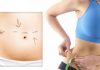 bơm mỡ bụng 