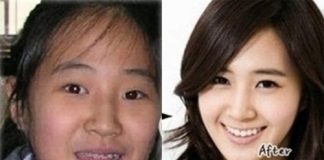 Đẩy lùi bọng mỡ ở mắt