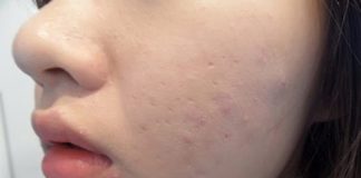 Muốn đẩy mụn ẩn, đừng quên mặt nạ mướp đắng