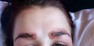 mặt bj phù nề và dị ứng 