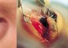 Những trường hợp côn trùng chui vào cơ thể gây chết người