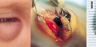 Những trường hợp côn trùng chui vào cơ thể gây chết người