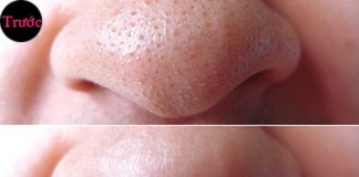 Cách lột mụn đầu đen tại nhà bằng sữa tươi