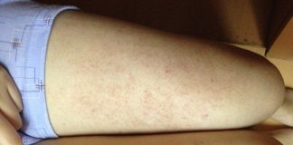 viêm lỗ chân lông 