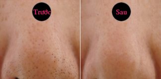 trị ụn đầu đen 