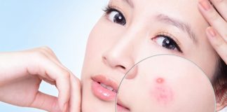 trị mụn tự nhiên