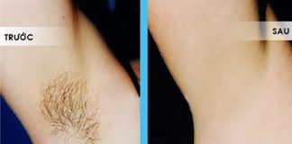 tẩy lông nách 