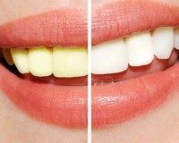 Phương pháp làm trắng răng vô hại nhất bạn nên dùng