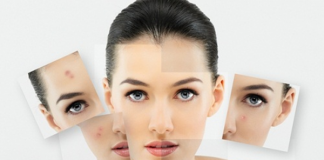 công thức trị mụn cám hiệu quả