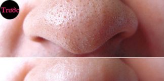 sạch mụn đầu đen 