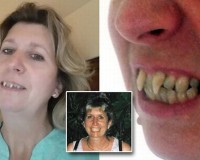 Choáng váng người phụ nữ có hàm răng ma cà rồng