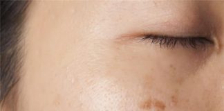 Hãy cân nhắc triệt lông bằng laser vì 9 tác dụng phụ sau