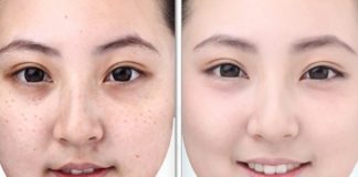 trị nám da