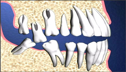 Những trường hợp chỉ định nhổ răng khôn - 9