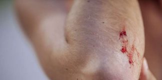 Những mẹo sơ cấp cứu sai lầm gây nguy hiểm sức khỏe1