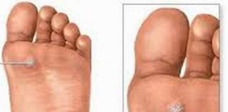 Một số bài thuốc trị chai chân 1