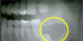 Những trường hợp chỉ định nhổ răng khôn - 1