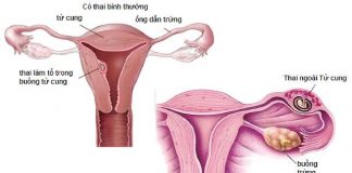 Mang thai ngoài tử cung, nguy cơ gây vô sinh ở phụ nữ-`