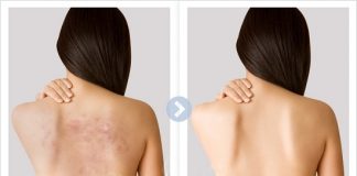 trị mụn trứng cá ở lưng