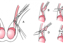 Thắt ống dẫn tinh, giải đáp những thắc mắc thường gặp-1