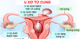 dau-hieu-nguyen-nhan-va-cach-phong-ngua-benh-u-xo-tu-cung