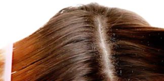 Bí quyết trị gàu đơn giản, hiệu quả - 1