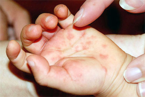 Các bệnh truyền nhiễm thường gặp vào mùa thu - 4