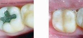 Trám răng, khi nào cần?