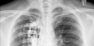 10 dấu hiệu cảnh báo sớm bệnh ung thư phổi