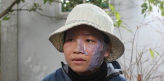 Nghi án thiếu phụ bị chồng xén tóc, nướng bát inox dí vào mặt