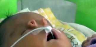 Xót xa bé trai chào đời với 4 lỗ mũi trên mặt