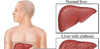 Bệnh Viêm gan B là gì ?