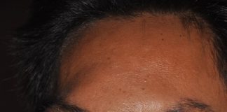 Ước mơ được cắt bỏ khối u khổng lồ của chàng trai đáng thương